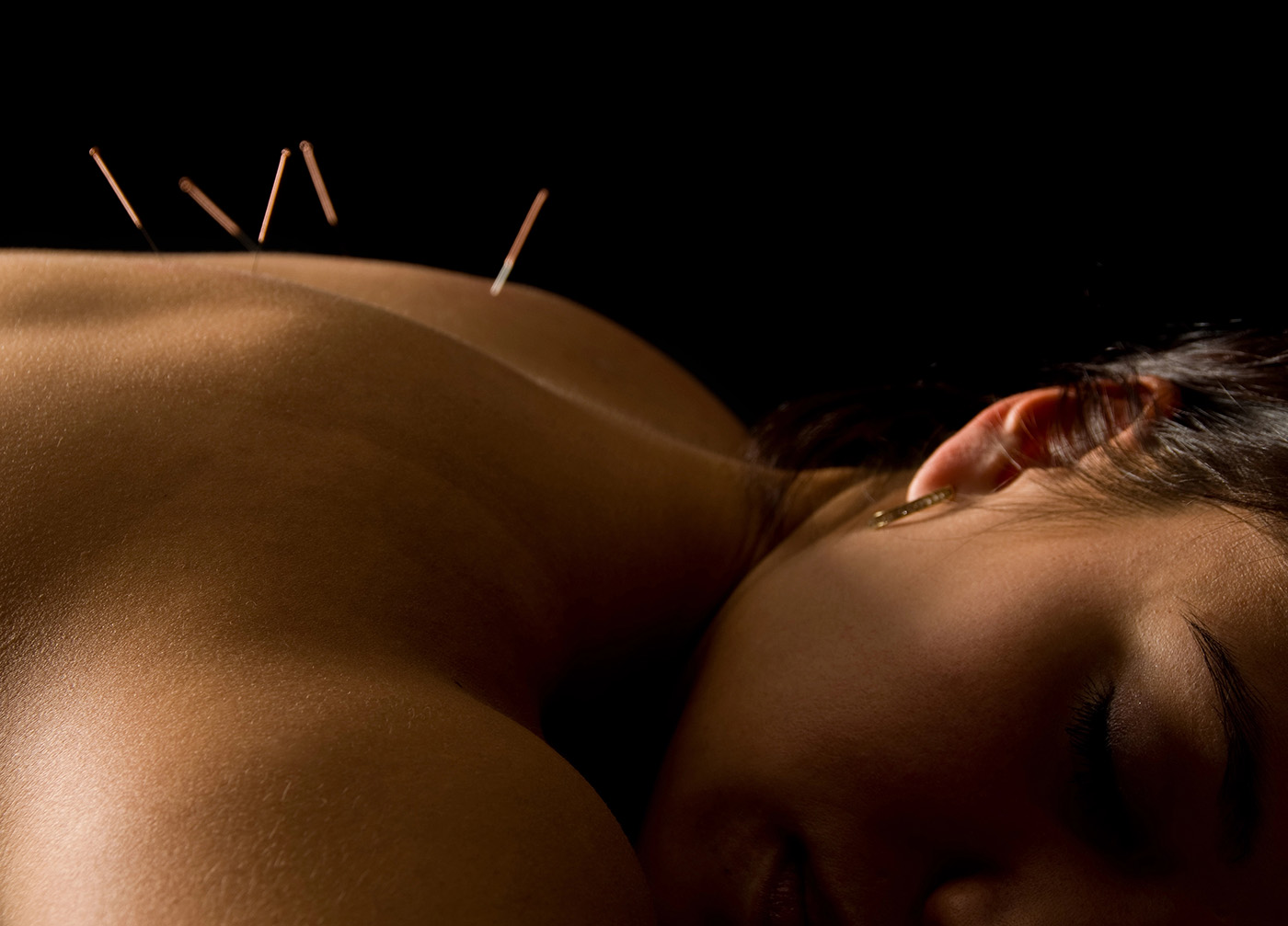 A person is lying on their stomach with several acupuncture needles inserted into their upper back, all set against a dark background.